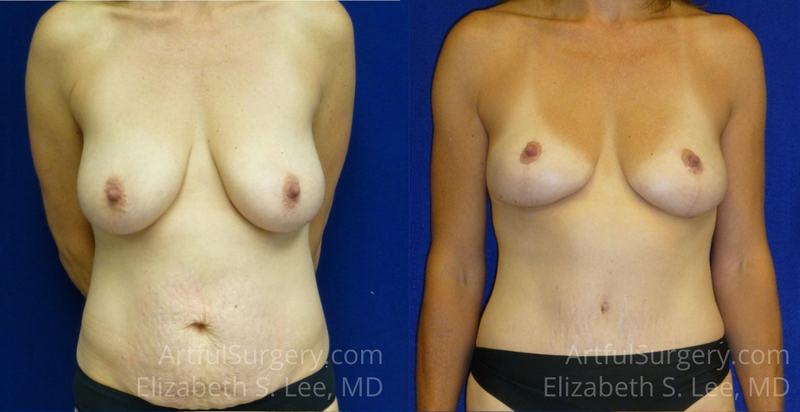 Picture of Mommy Makeover-05