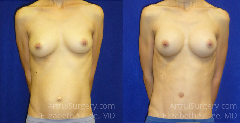 Picture of Mommy Makeover-06