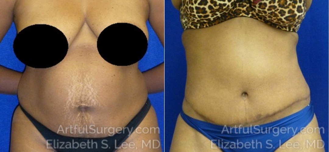 Picture of Tummy Tuck-12