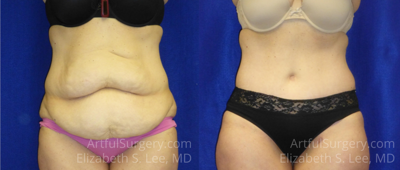 Picture of Tummy Tuck-13