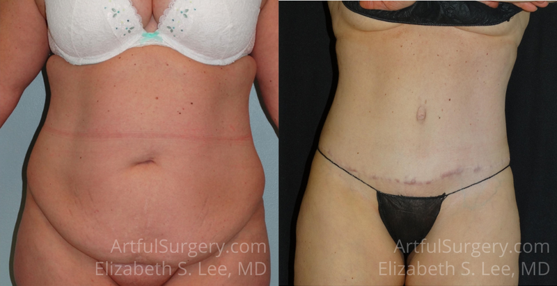 Picture of Tummy Tuck-14