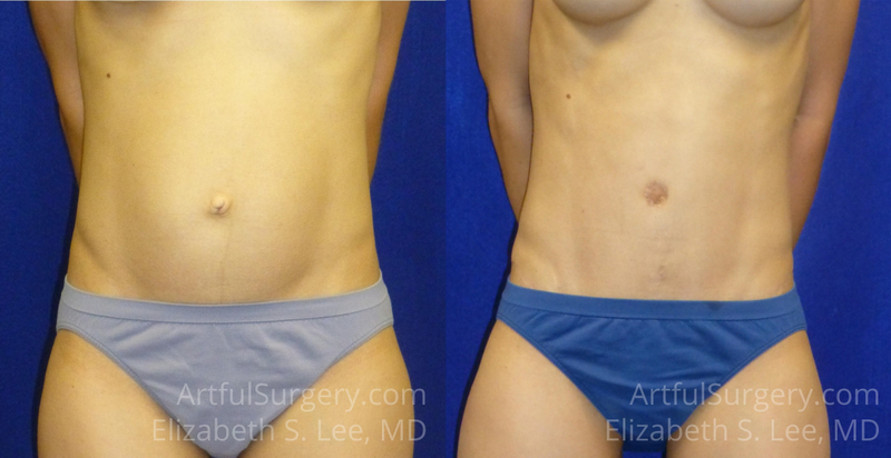 Picture of Tummy Tuck-15