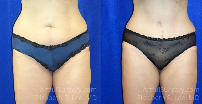 Picture of Tummy Tuck-17