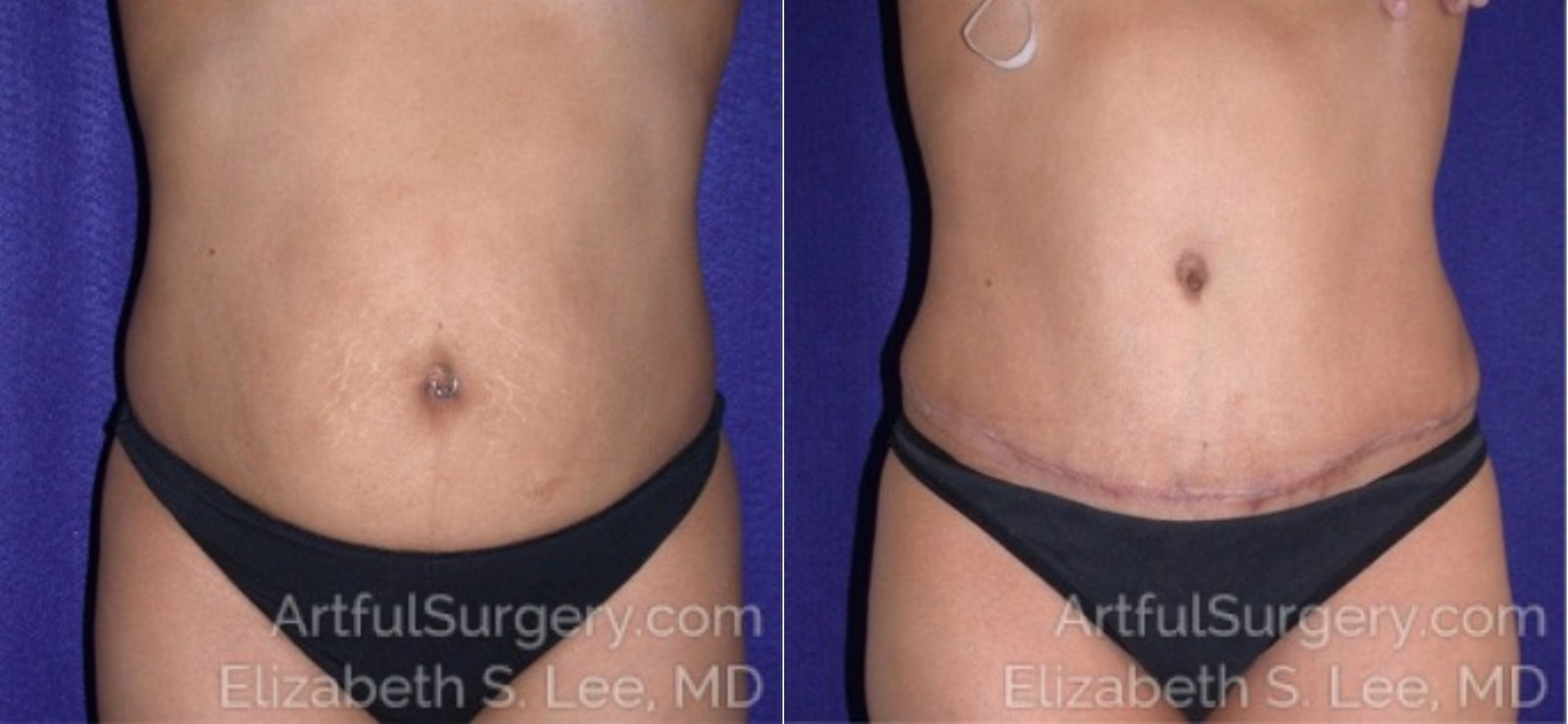 Picture of Tummy Tuck-07