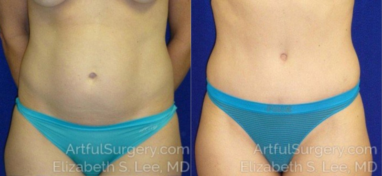 Picture of Tummy Tuck-09
