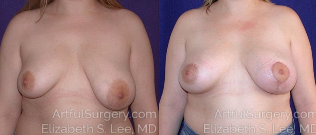 Picture of Asymmetric Breast Surgery 2