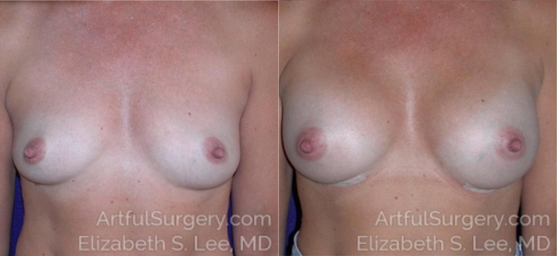 Picture of Breast Augmentation-10