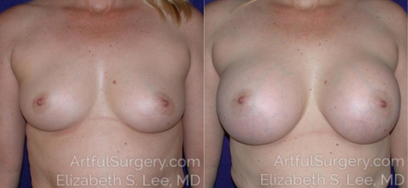 Picture of Breast Augmentation-13