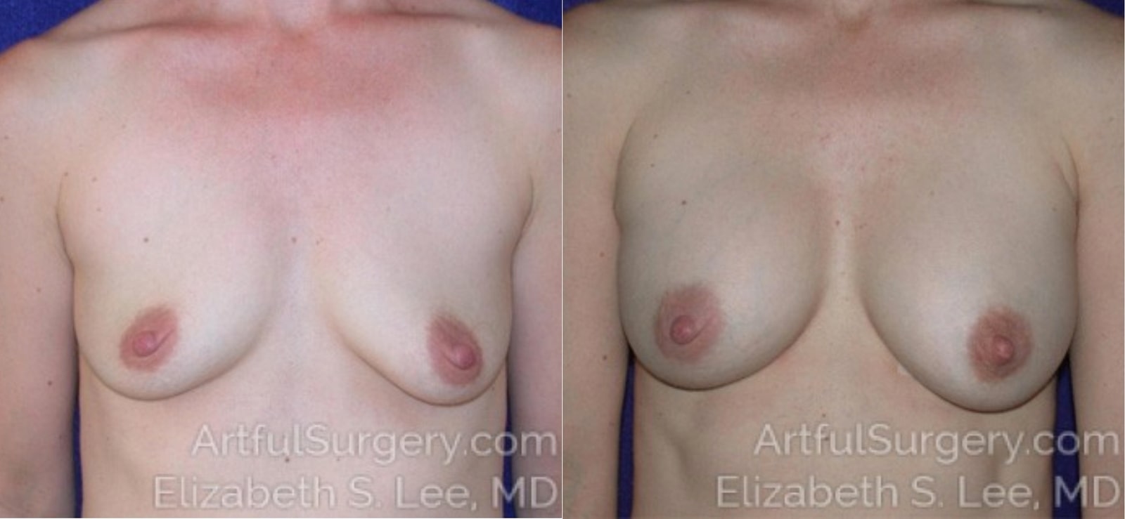 Picture of Breast Augmentation-15
