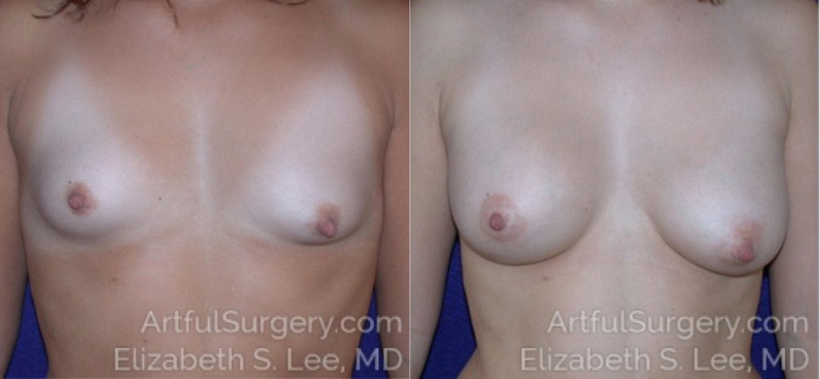 Picture of Breast Augmentation-17