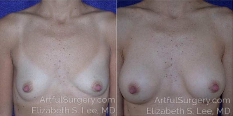 Picture of Breast Augmentation-18