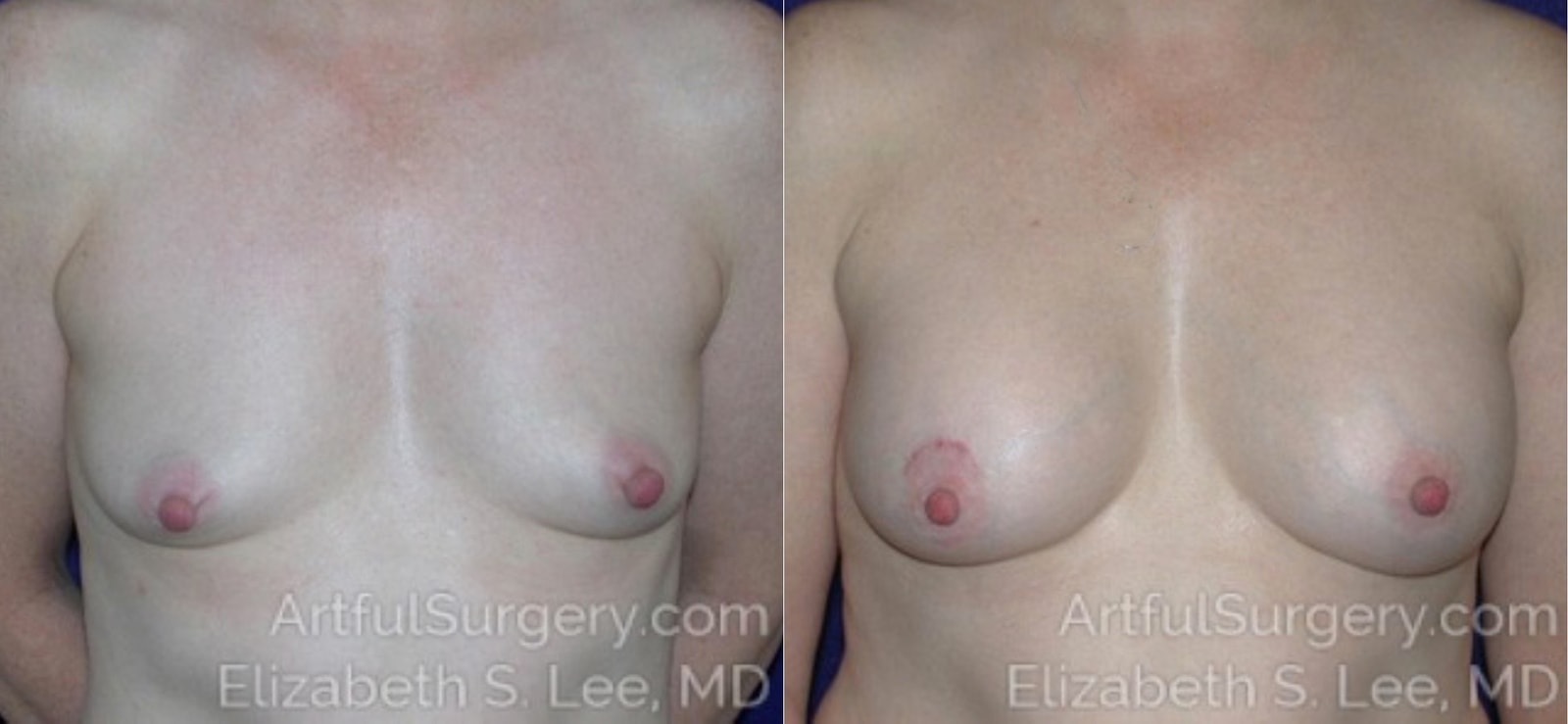 Picture of Breast Augmentation-21