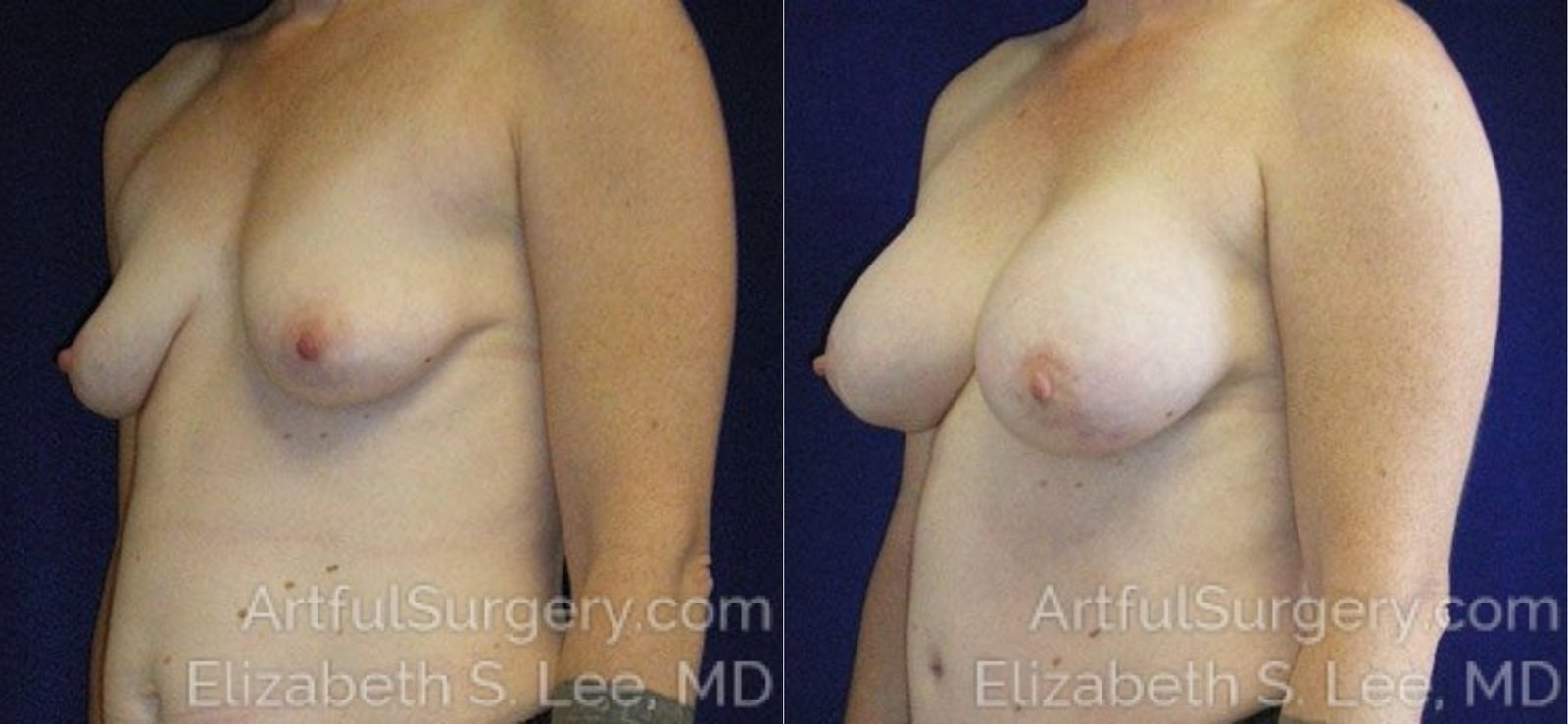 Picture of Breast Augmentation-4
