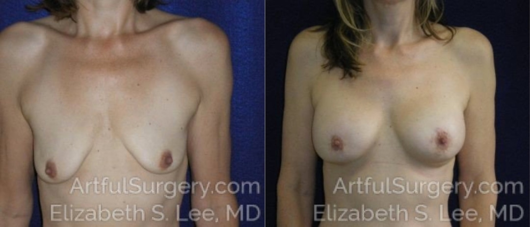 Picture of Breast Augmentation-5