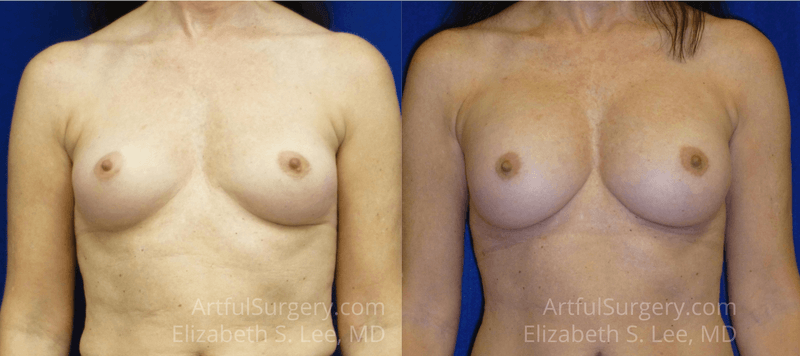 Picture of Breast Augmentation-8