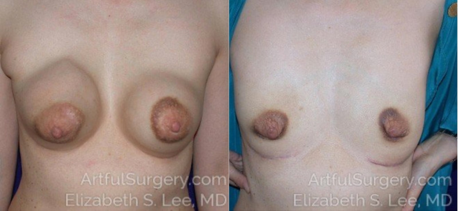 Picture of Breast Implant Removal-3