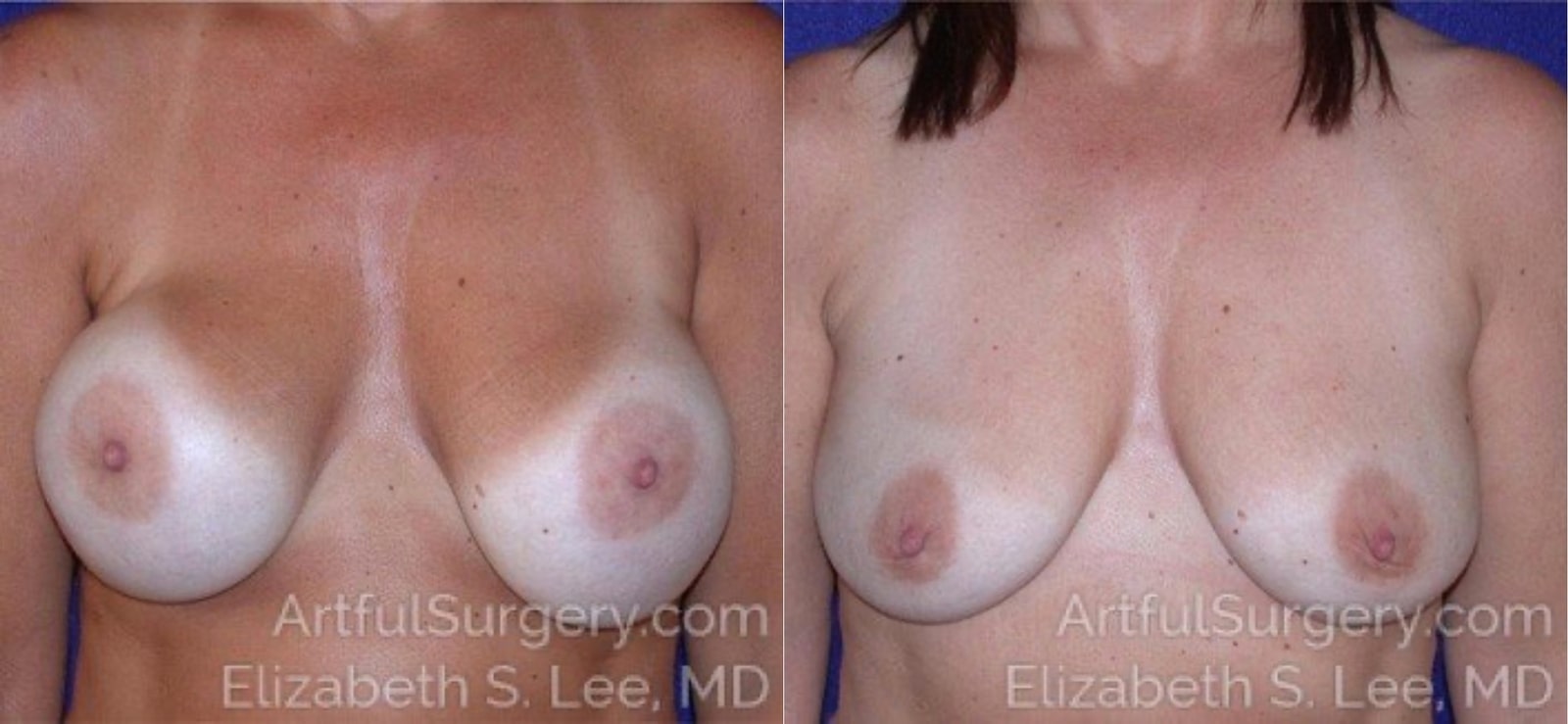 Picture of Breast Implant Removal-4