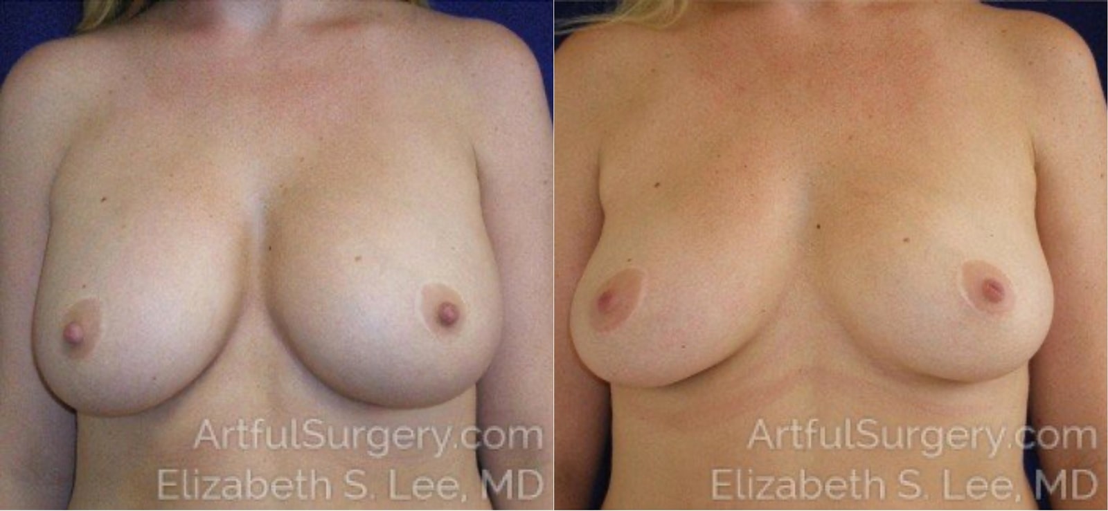 Picture of Breast Implant Removal-5