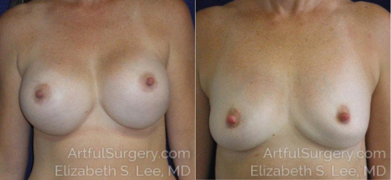 Picture of Breast Implant Removal-6