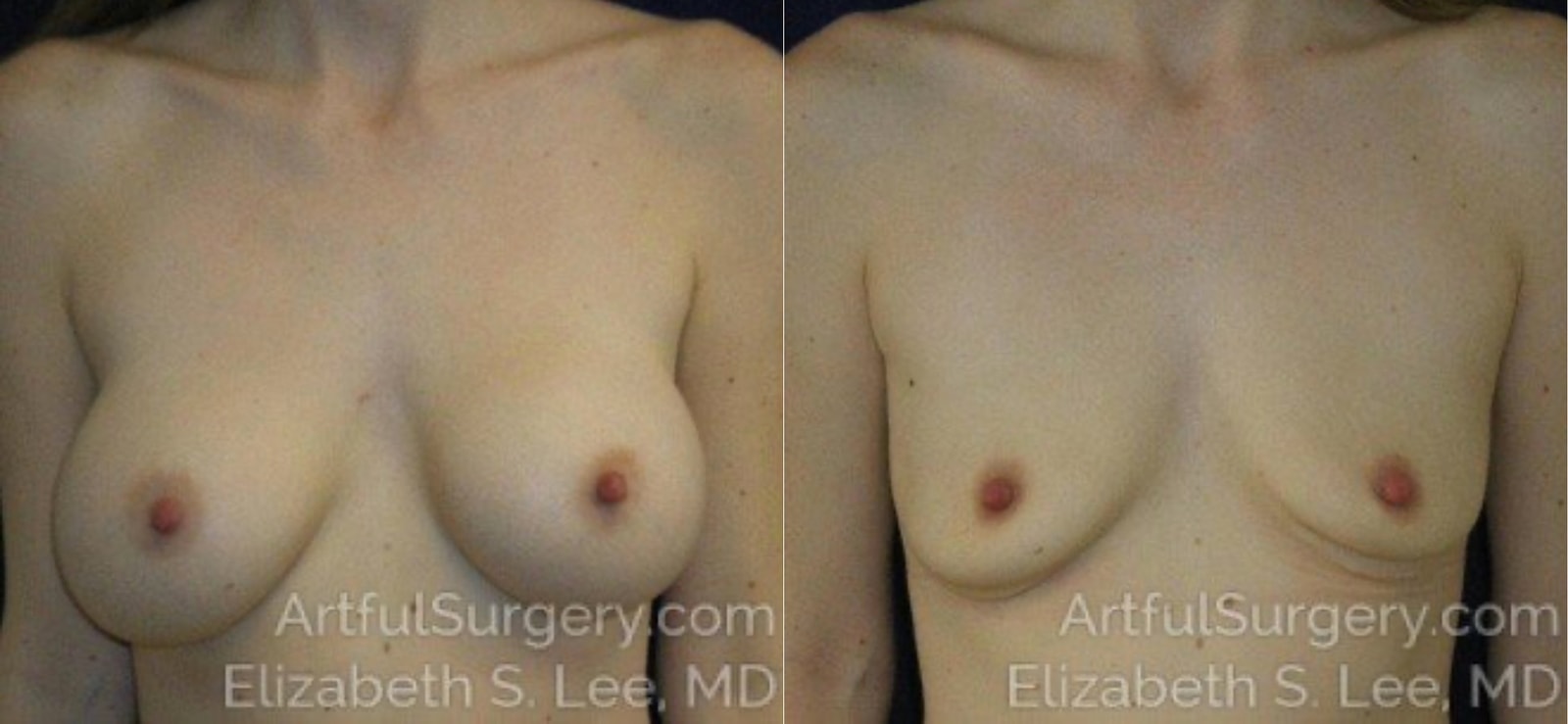 Picture of Breast Implant Removal-8