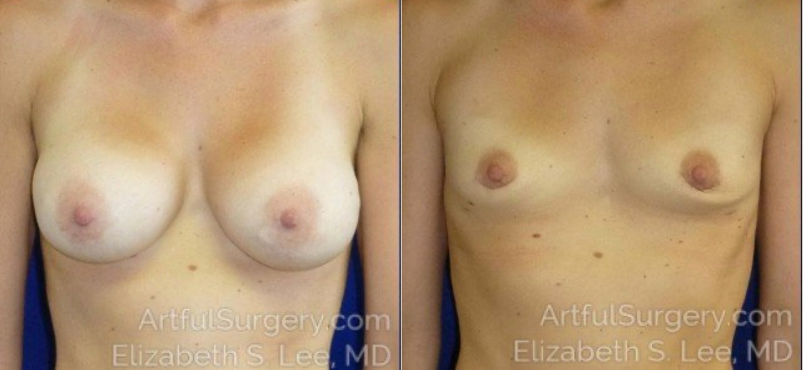 Picture of Breast Implant Removal-9