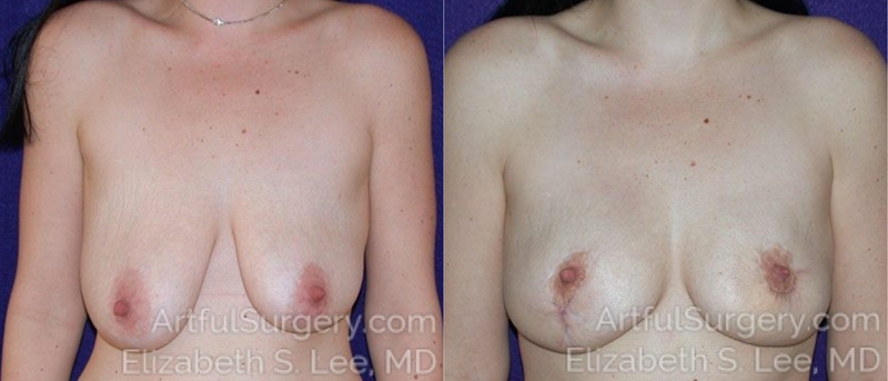 Picture of Breast Lift-11