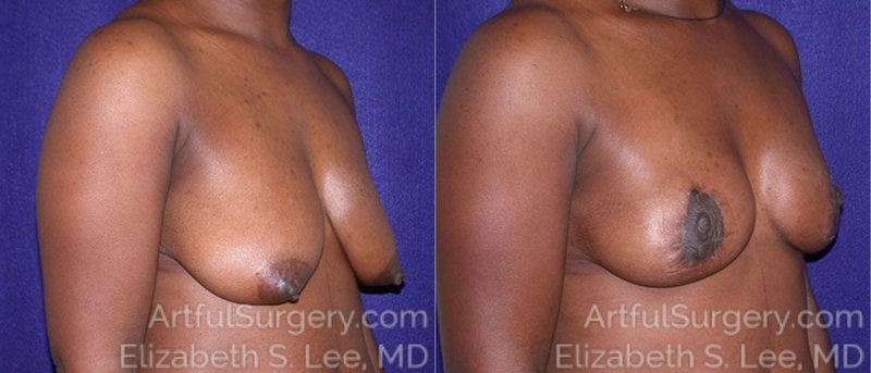 Picture of Breast Lift-12