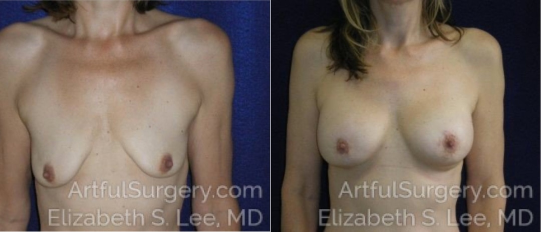 Picture of Breast Lift-14