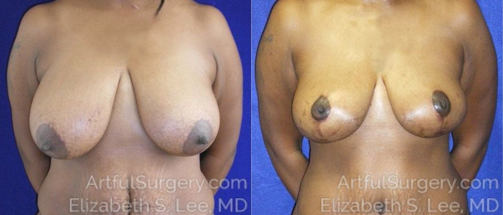 Picture of Breast Lift-20