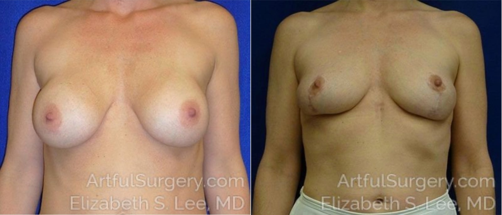 Picture of Breast Lift-22