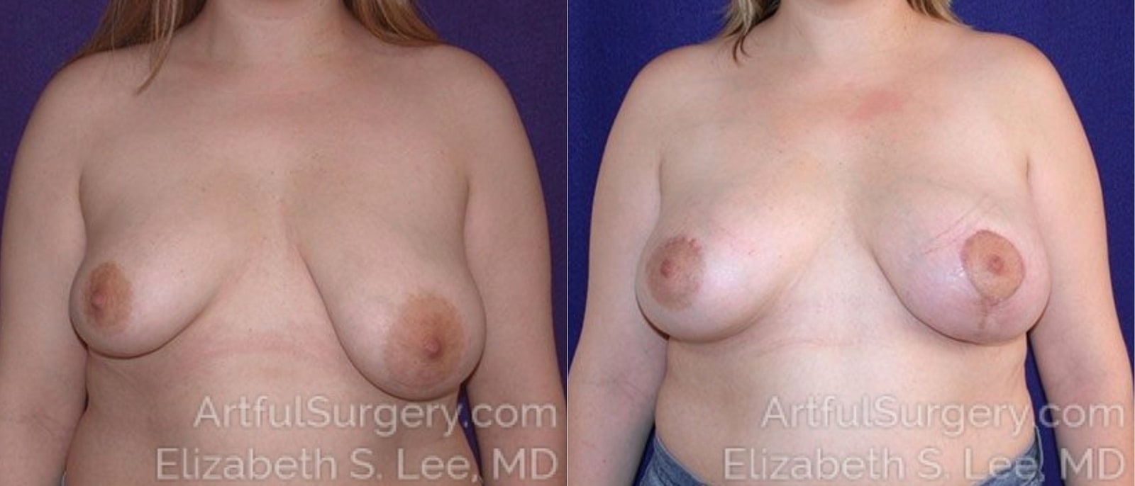 Picture of Breast Lift-5