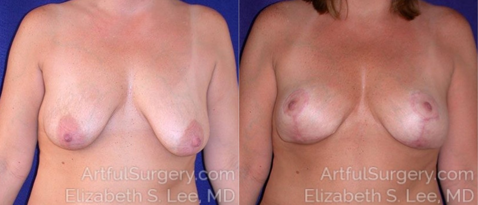 Picture of Breast Lift-6