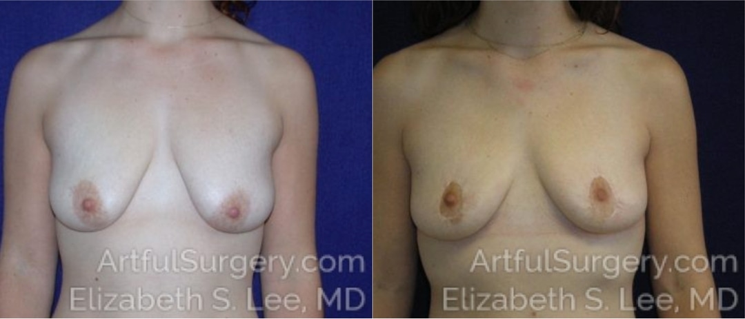 Picture of Breast Lift-7