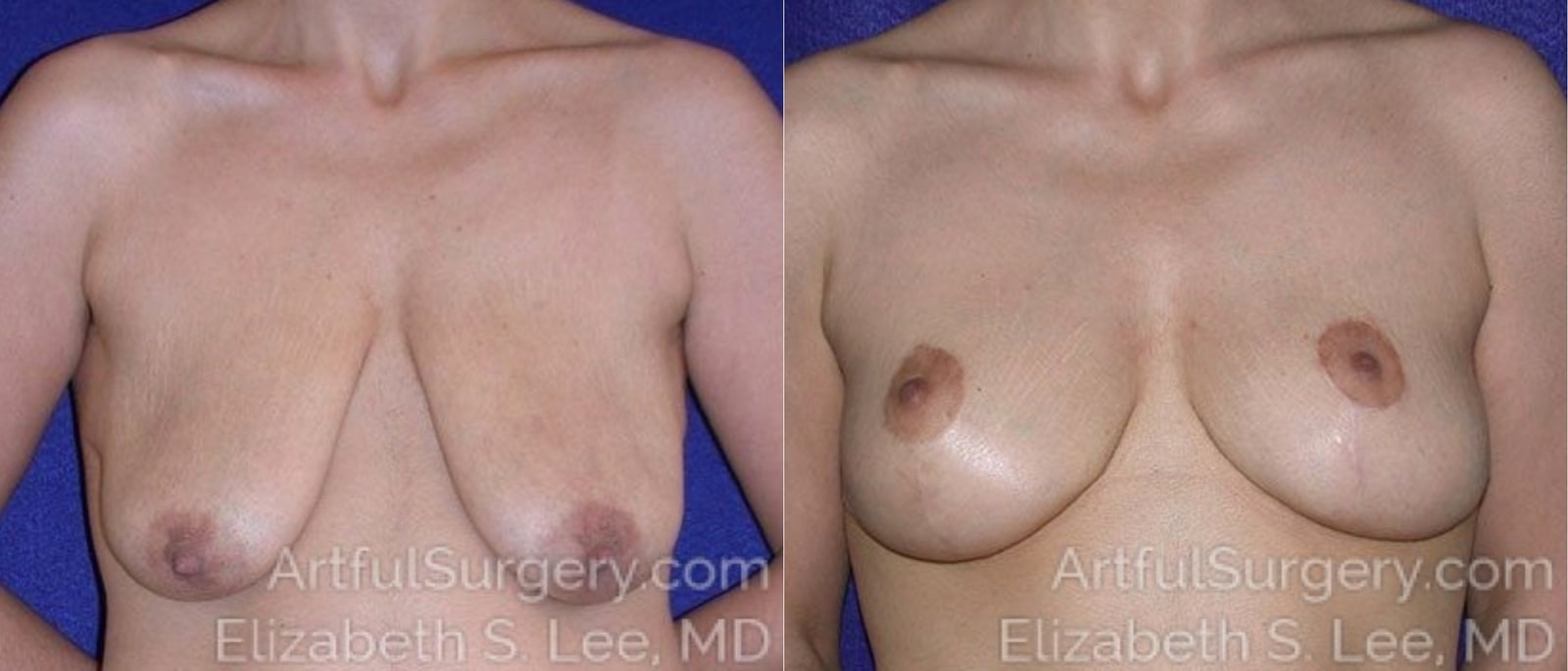 Picture of Breast Lift-8