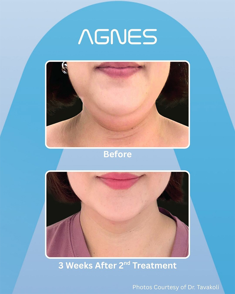 Picture of About Before Agnes2