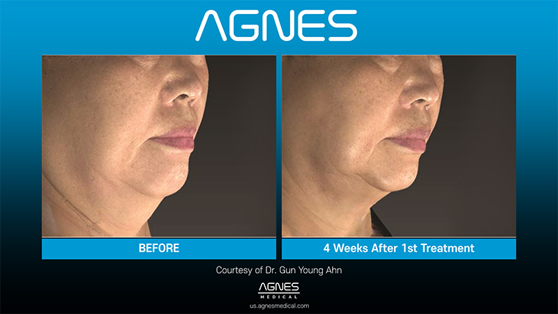 Picture of About Before Agnes