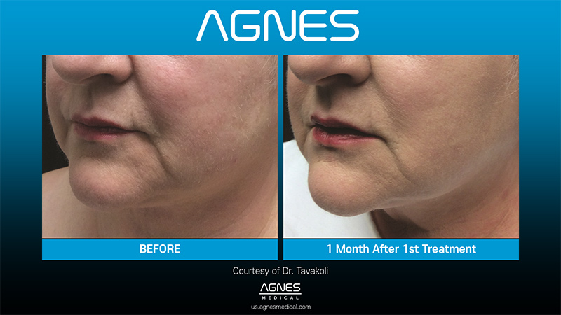 Picture of About Before Agnes1