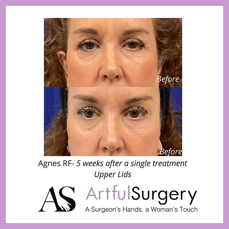 Picture of About Agnes RF3