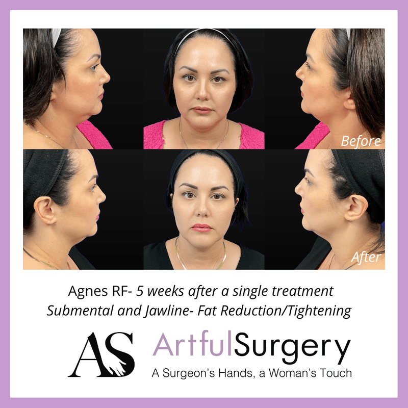 Picture of About Agnes RF4