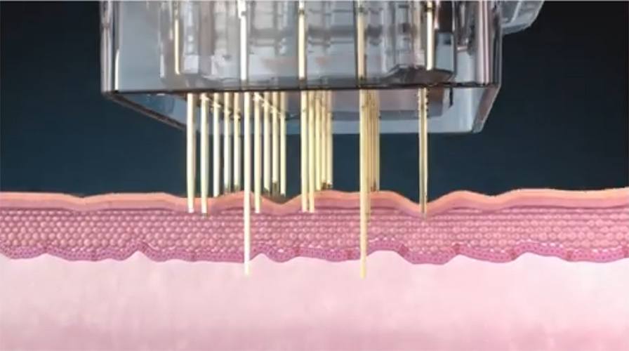 Picture of Agnes Ultra 3D