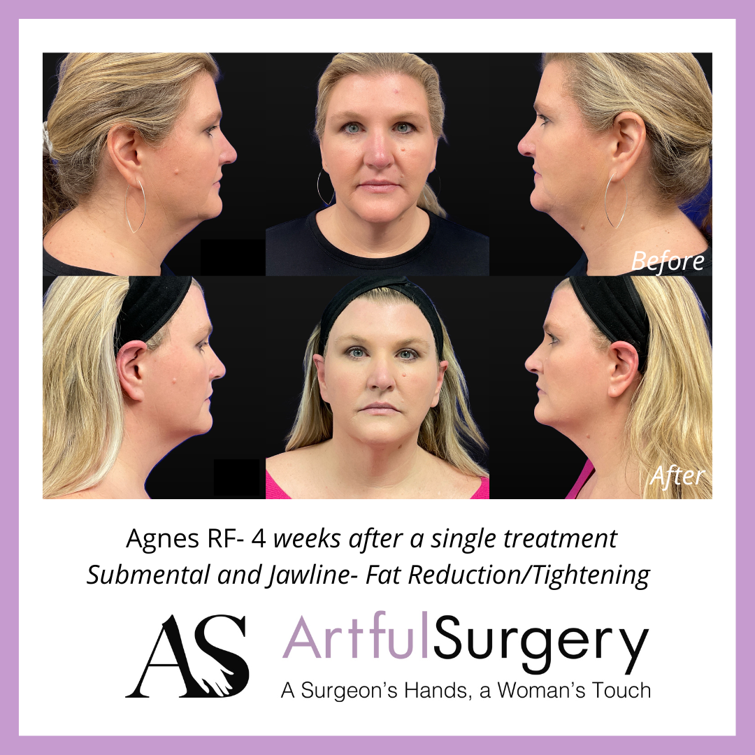 Picture of About Agnes RF5