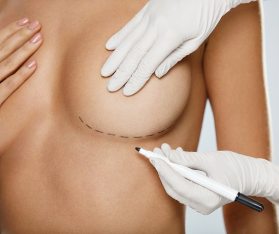 Breast Augmentation for an Asymmetric Breast Aug