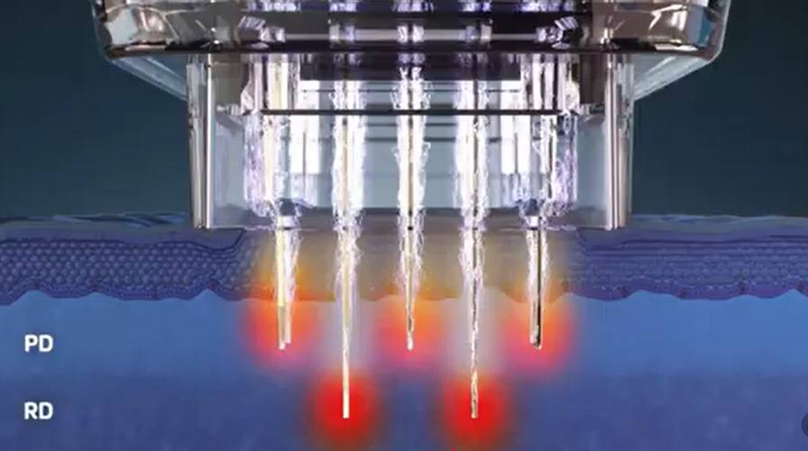 Picture of Agnes Ultra 3D