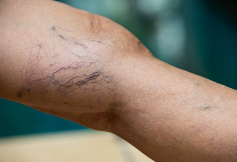 Picture of About Spider Vein Removal